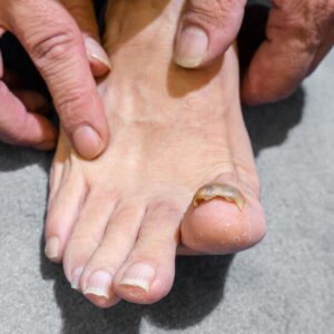 big-toe-person-suffering-from-onychomycosis-fungal-infection_651462-1743