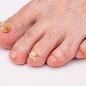 closeup-photo-woman-foot-with-fungal-disease-nails-onychomycosis-dermatology_753567-395